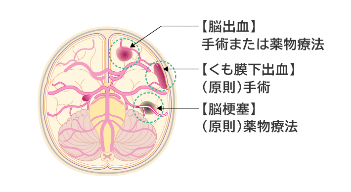 脳卒中のイメージ図