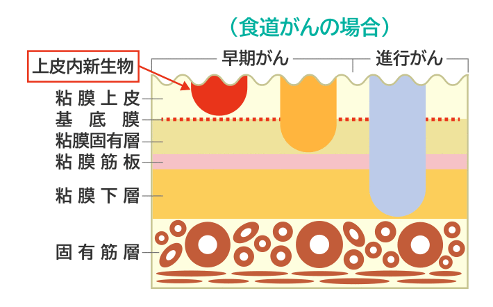 食道がんの場合